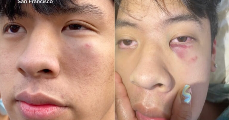 Fil-Am teen punched at San Francisco bar in alleged anti-Asian attack