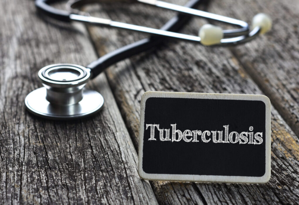 Tuberculosis Exposure Reported at St. Michael’s Catholic Church